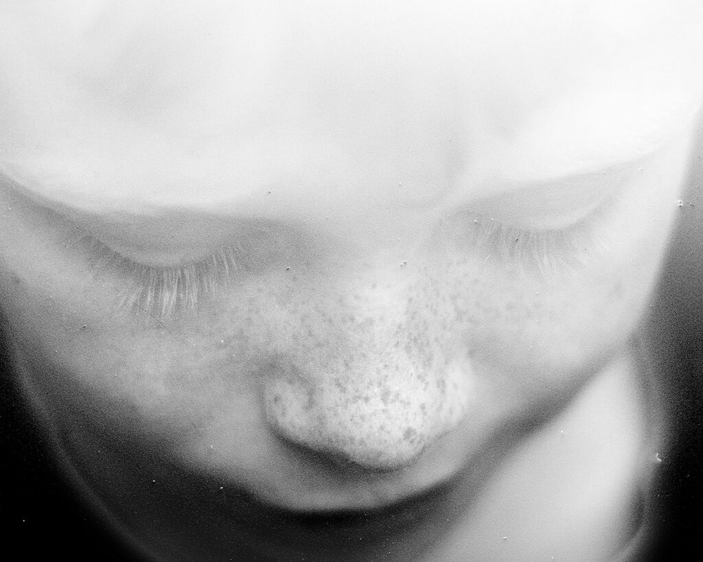 fotografia artistica volto albino lentiggini bianco e nero